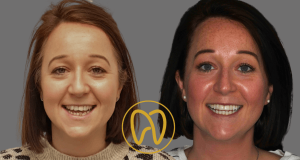 Invisalign transformation